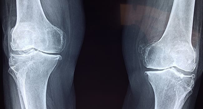 Why most knee injuries don’t need surgery to heal