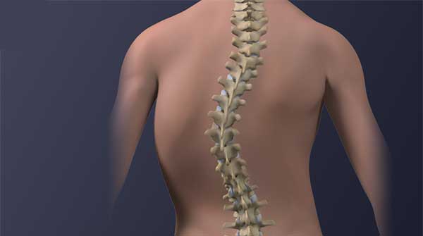 Portable ultrasound helps detect scoliosis in teens